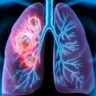 lungs-cancer-signs