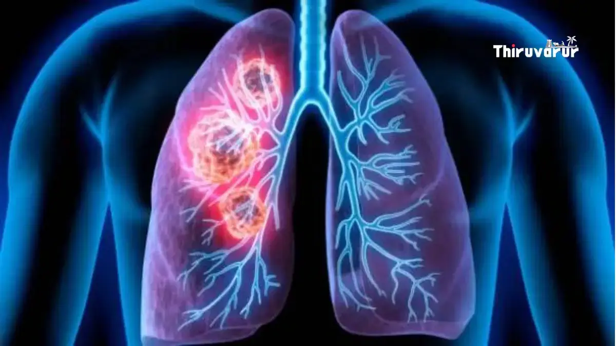 lungs-cancer-signs